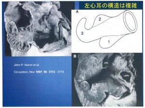 図3 左心耳の構造